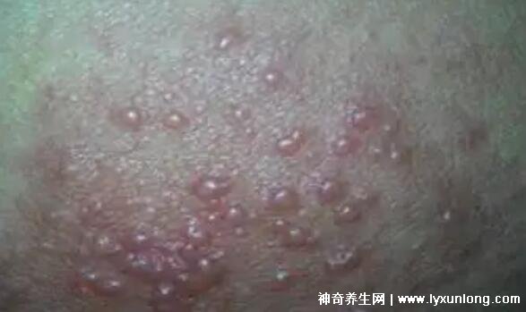 男性疣是什么樣子圖片，尖銳濕疣/扁平疣/絲狀疣發(fā)病部位不同