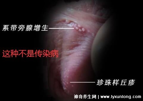 初期尖銳濕尤圖癥狀圖片男性,淡紅色小疙瘩變大為菜花狀疣體-易網(wǎng)健康養(yǎng)生網(wǎng) 初期尖銳濕尤圖癥狀圖片男性,淡紅色小疙瘩變大為菜花狀疣體