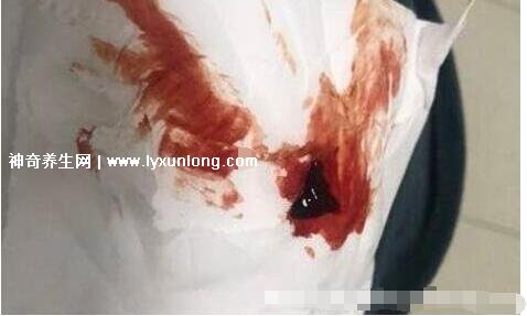 真實女生內膜破壞的圖片，剝脫的子宮內膜伴隨經血排出