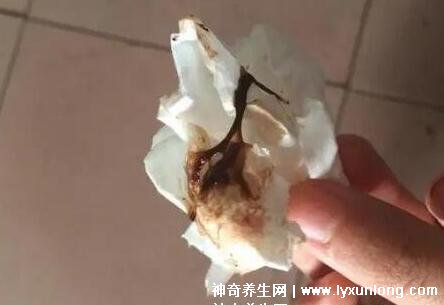 宮頸癌褐色分泌物圖片，少量不規(guī)則出血伴隨X交痛(腥臭分泌物)