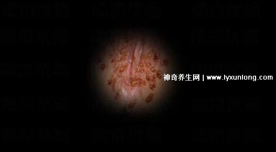 初期女士濕銳疣圖片早期，口腔尖銳濕癥狀太嚇人了(菜花樣疣體)