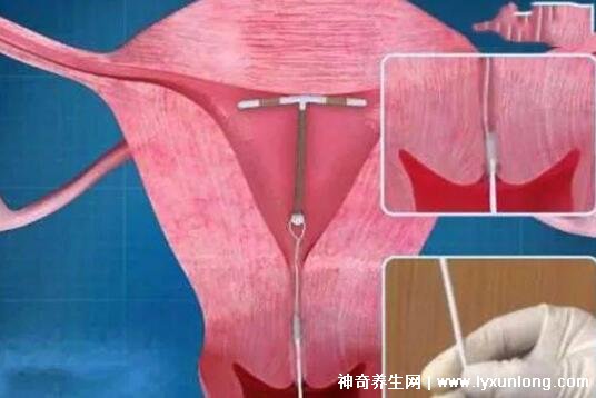 打一針不懷孕的針多少錢價格，69元避孕一個月(6款避孕針價格表)