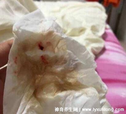 宮頸癌褐色分泌物圖片，少量不規(guī)則出血伴隨X交痛(腥臭分泌物)