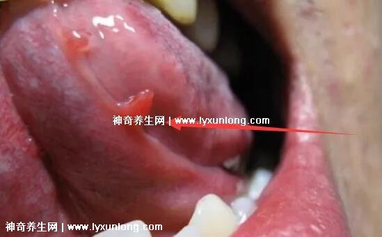 初期女士濕銳疣圖片早期，口腔尖銳濕癥狀太嚇人了(菜花樣疣體)