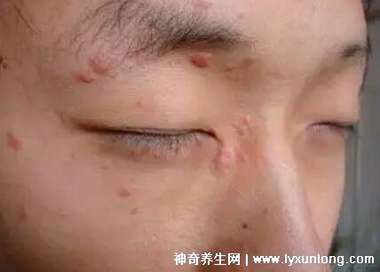 男性疣是什么樣子圖片，尖銳濕疣/扁平疣/絲狀疣發(fā)病部位不同