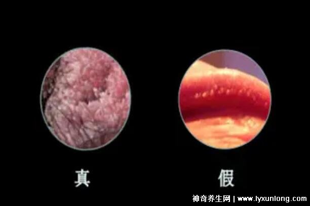 女性假疣和真疣的圖片對比，前者淡紅色和淡褐色魚子狀(5大區(qū)別)