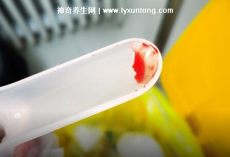 宮頸癌褐色分泌物圖片，少量不規(guī)則出血伴隨X交痛(腥臭分泌物)