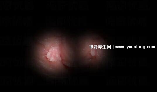 初期女士濕銳疣圖片早期，口腔尖銳濕癥狀太嚇人了(菜花樣疣體)