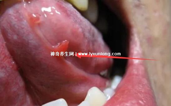 男性疣是什么樣子圖片，尖銳濕疣/扁平疣/絲狀疣發(fā)病部位不同