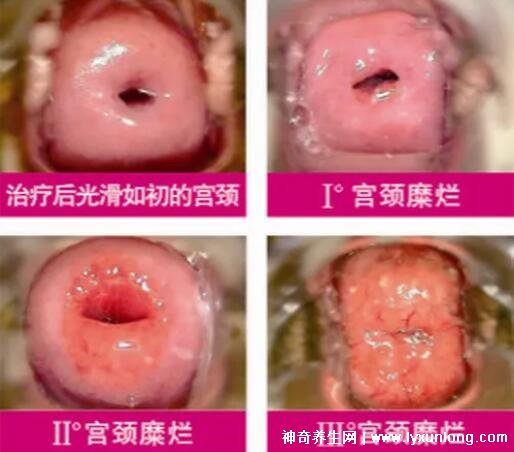 宮頸癌褐色分泌物圖片，少量不規(guī)則出血伴隨X交痛(腥臭分泌物)