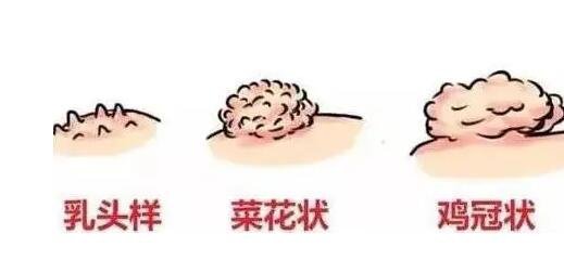 初期尖銳濕尤圖癥狀圖片男性,淡紅色小疙瘩變大為菜花狀疣體-易網(wǎng)<a href=http://www.gyfww.com/ target=_blank class=infotextkey>健康養(yǎng)生</a>網(wǎng) 初期尖銳濕尤圖癥狀圖片男性,淡紅色小疙瘩變大為菜花狀疣體