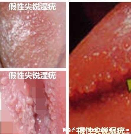 女性假疣和真疣的圖片對比，前者淡紅色和淡褐色魚子狀(5大區(qū)別)