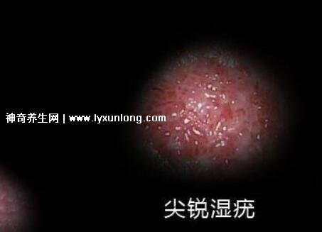 初期女士濕銳疣圖片早期，口腔尖銳濕癥狀太嚇人了(菜花樣疣體)