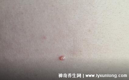 男性疣是什么樣子圖片，尖銳濕疣/扁平疣/絲狀疣發(fā)病部位不同