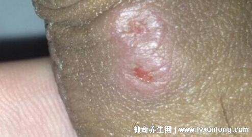 初期尖銳濕尤圖癥狀圖片男性,淡紅色小疙瘩變大為菜花狀疣體-易網(wǎng)健康養(yǎng)生網(wǎng) 初期尖銳濕尤圖癥狀圖片男性,淡紅色小疙瘩變大為菜花狀疣體