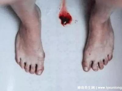 真實女生內膜破壞的圖片，剝脫的子宮內膜伴隨經血排出