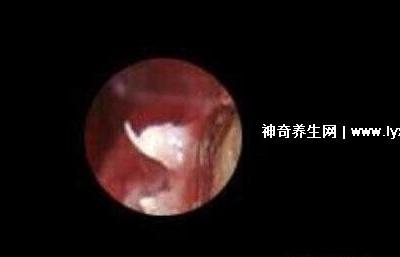 初期女士濕銳疣圖片早期，口腔尖銳濕癥狀太嚇人了(菜花樣疣體)