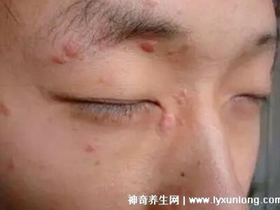 男性疣是什么樣子圖片，尖銳濕疣/扁平疣/絲狀疣發病部位不同