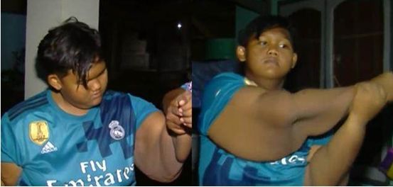 印尼400斤胖男孩終于瘦下來了，減肥成功的他讓人不敢相信