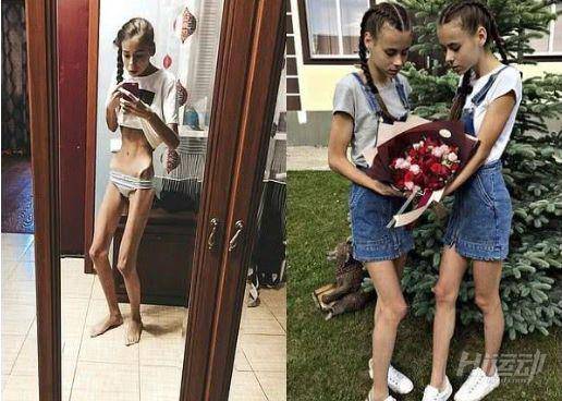 為成為模特這對雙胞胎做了這件事，患上厭食癥還成了“老奶奶”