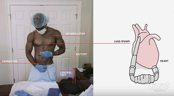 每天先充電才能活！小伙靠人工心臟續命，依然堅持健身