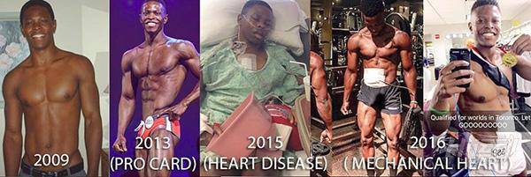 每天先充電才能活！小伙靠人工心臟續命，依然堅持健身