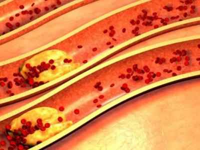 世界上最胖的人減了660斤 肥胖有哪些危害