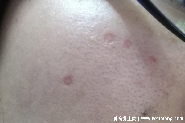 千萬不要激光點痣后悔一輩子，可導致惡性黑色素瘤(共3個危害)