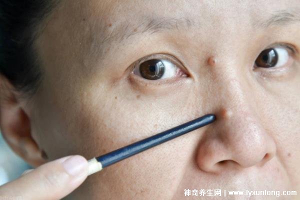 千萬不要激光點痣后悔一輩子，可導致惡性黑色素瘤(共3個危害)