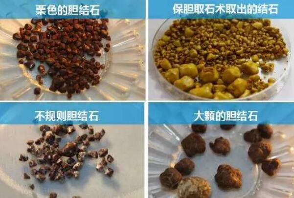 三個動作排出膽結石,肩橋/腰部扭轉/前傾動作促排結石-易網<a href=http://www.gyfww.com/ target=_blank class=infotextkey>健康養生</a>網 三個動作排出膽結石,肩橋/腰部扭轉/前傾動作促排結石