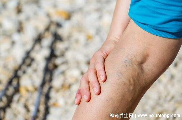 靜脈曲張最怕三種運動，散步瑜伽和游泳(附最快消除方法)