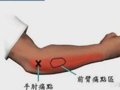 網球肘最怕三個動作，反手拍球/手腕彎曲/提重物/做家務