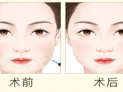 減肥溶脂針安全嗎