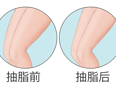 腿部抽脂多久能恢復
