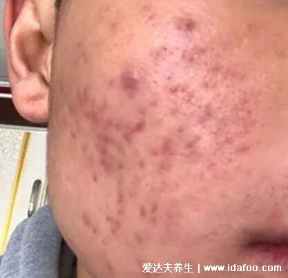 暗瘡圖片是什么樣子，暗瘡和痤瘡有區別(不形成膿包)