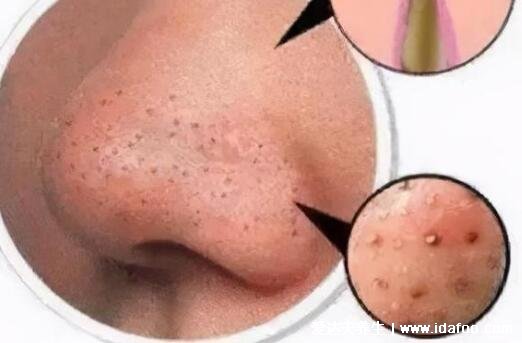 暗瘡圖片是什么樣子，暗瘡和痤瘡有區別(不形成膿包)