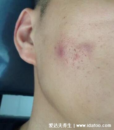 暗瘡圖片是什么樣子，暗瘡和痤瘡有區別(不形成膿包)