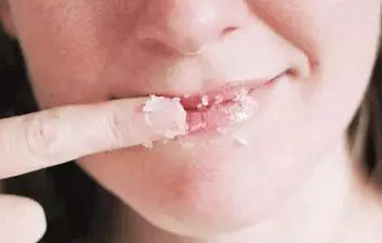  嘟嘴賣萌?麻煩先把唇部保養好再說 