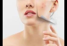 如何有效祛痘印 這些方法助你肌膚無(wú)暇