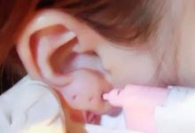 女子路邊攤打耳洞 5年后耳垂變?nèi)饬?  style=