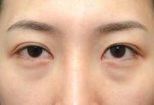  為什么會出現眼袋？怎樣有效去眼袋？