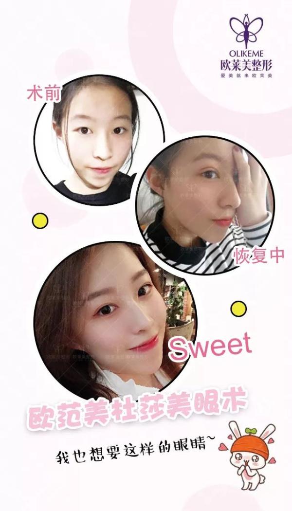 義烏割雙眼皮價(jià)格?歐萊美免費(fèi)做雙眼皮招募中！