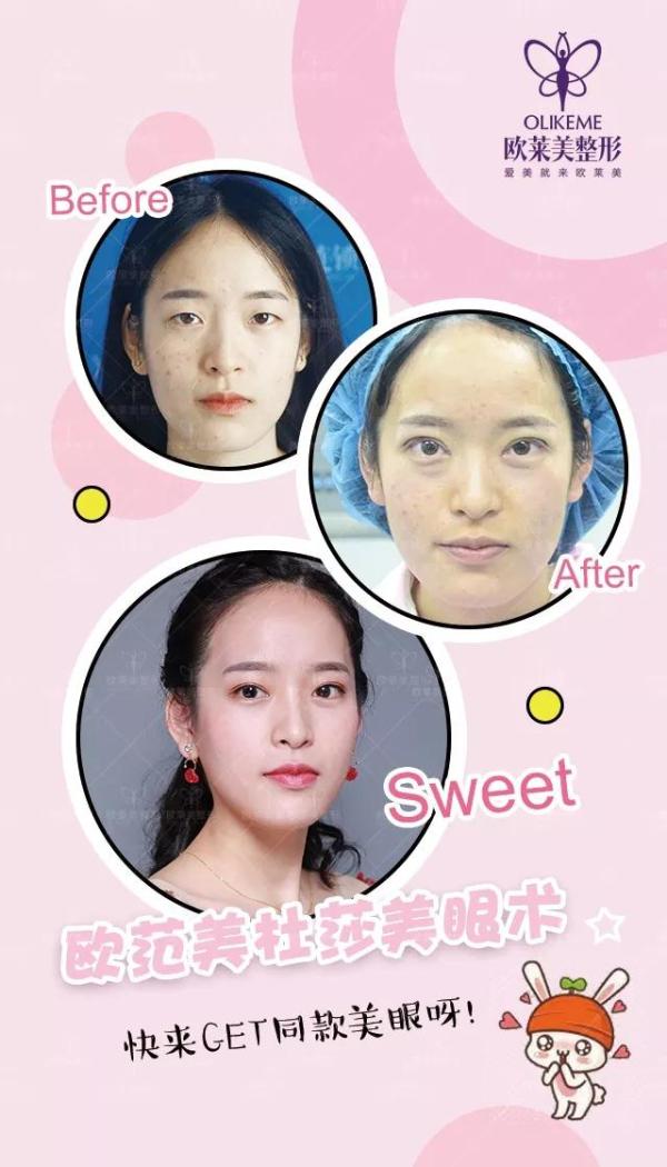 義烏割雙眼皮價(jià)格?歐萊美免費(fèi)做雙眼皮招募中！