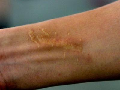 惹人厭的瘢痕 有哪些辦法“抹平”