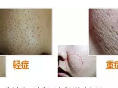 肌膚毛孔空隙的三種不同類型，女性都想了解的護(hù)膚小知識(shí)