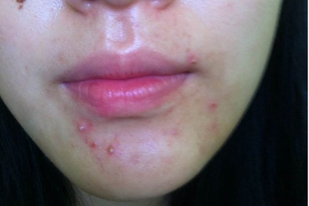 女性長膿包型痤瘡怎么治理，紅腫膿皰護理不當容易留痘疤