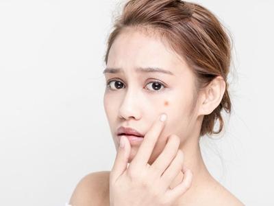 面部痤瘡如何治療，女性針對不同膚質進行治療最佳方法