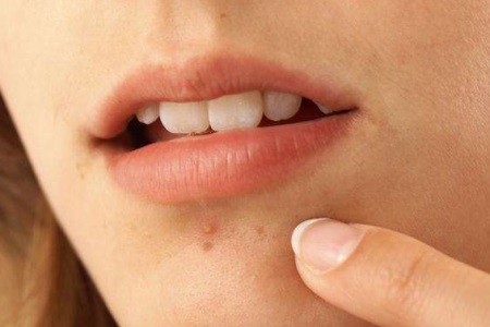 面部痤瘡下巴長痘，鼻子長黑頭，最佳的治療方式是選擇它