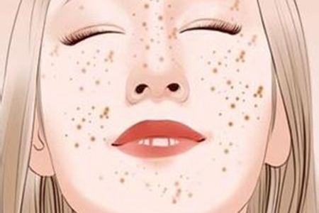 女性激光祛斑會反彈嗎，醫美后五個注意事項