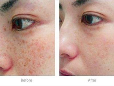 女性激光祛斑會反彈嗎，醫(yī)美后五個注意事項